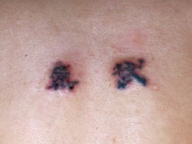 tattoo removal before and after. cost snl lower back laser