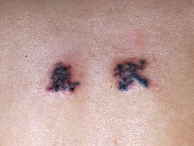 how to remove temporary tattoos. laser removal tattoo cost snl lower back