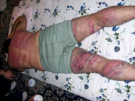 Wounds from whipping in Iran