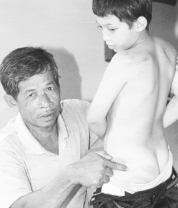 Mindar showing the marks on Mohd Ashrul's buttocks