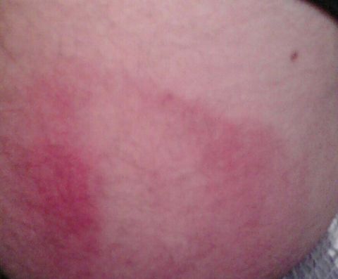 bruised buttock